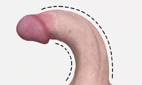 induratio_penis_plastica_ipp